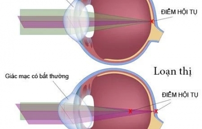 LOẠN THỊ NGUYÊN NHÂN TRIỆU CHỨNG VÀ CÁCH ĐIỀU TRỊ